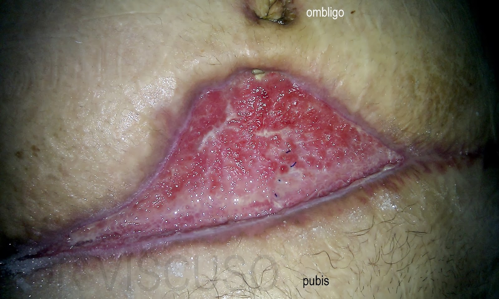 El precio de la crema akrustal de la psoriasis
